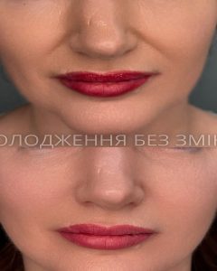 Ботокс та біоревіталізація на Троєщині