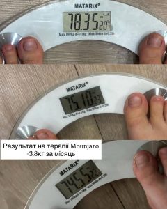 Результати терапії Мунджаро для схуднення — кабінет косметолога Троєщина